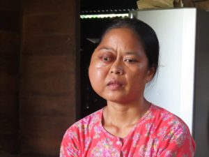 Bupati Paluta? Diminta Bantu Warga Sakit Tumor Parah Ini Oleh Masyarakatnya