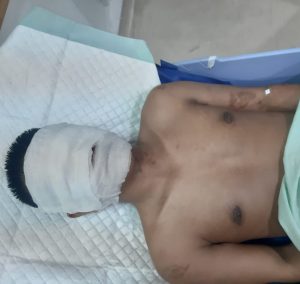 Sadis! Wartawan Media Online di Medan Alami Luka Parah di Wajah, Diduga Disiram Air Keras