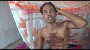 Habis di Vaksin, Buruh BHL PT. CKI Alami Luka Seperti Terbakar di Sekujur Tubuhnya