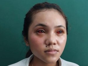 Mahasiswi Malang Ini Terpapar Gas Air Mata Kedaluwarsa: Efeknya Tetap Memerah!